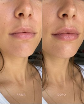 Hyaluronic Volumizer balsamo labbra