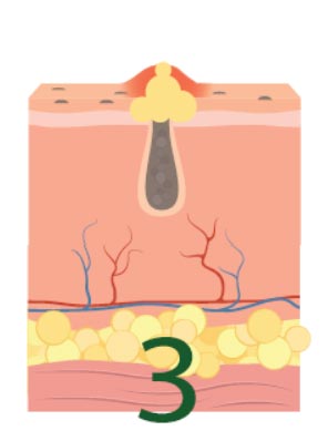 Trattamento specifico contro acne e brufoli